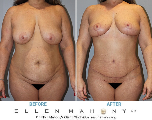 Before and After Image: Case #10601 - front