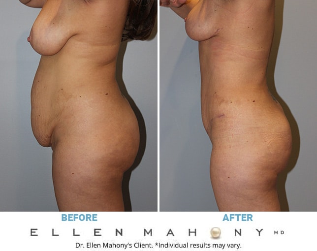 Before and After Image: Case #10601 - left-side