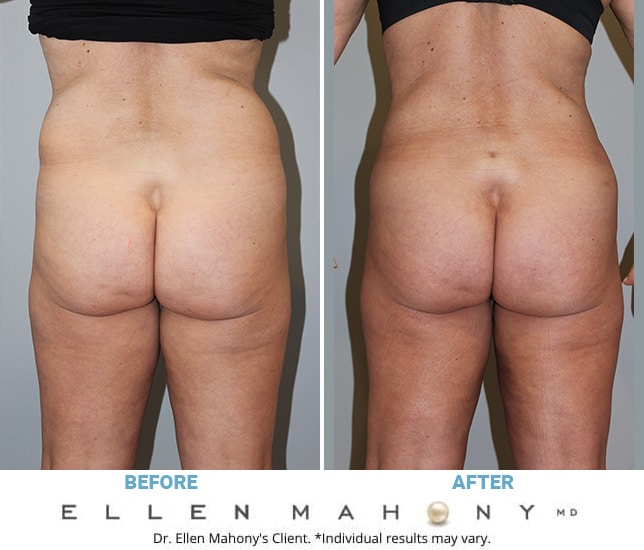 Before and After Image: Case #6327 - back