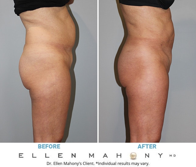 Before and After Image: Case #6327 - right-side