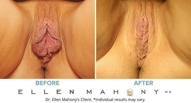 Before and After Image: Case #10074 - front