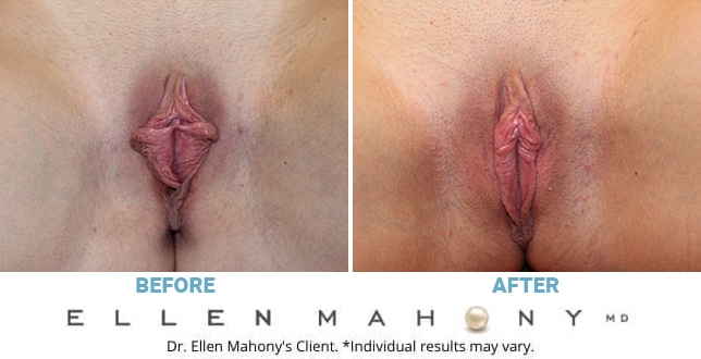 Before and After Image: Case #11366 - front
