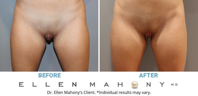Before and After Image: Case #11988 - front