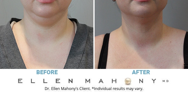 Before and After Image: Case #12184 - front