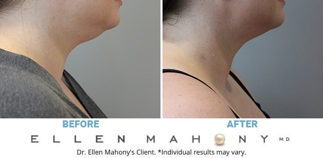 Before and After Image: Case #12184 - right-side