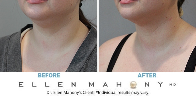 Before and After Image: Case #12184 - left-front-oblique