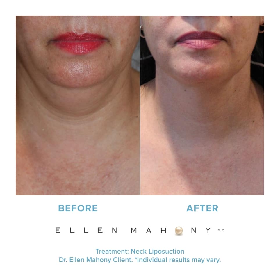 Before and After Image: Case #20921 - front