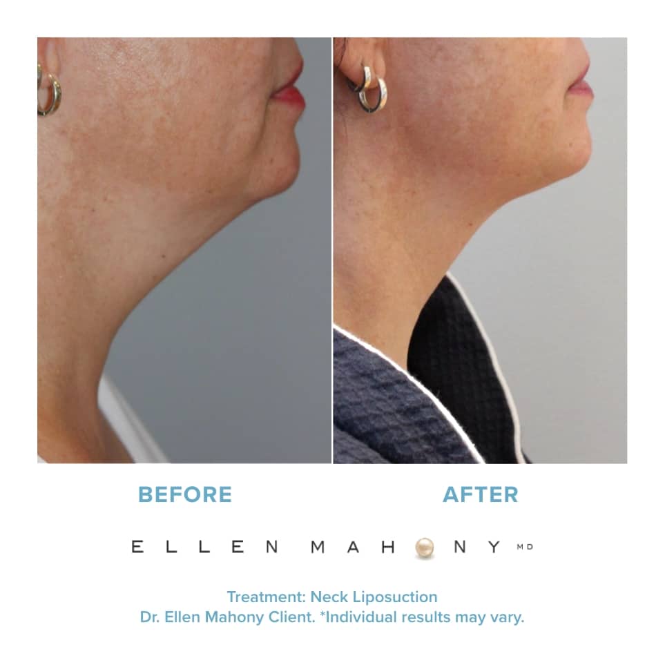 Before and After Image: Case #20921 - right-side