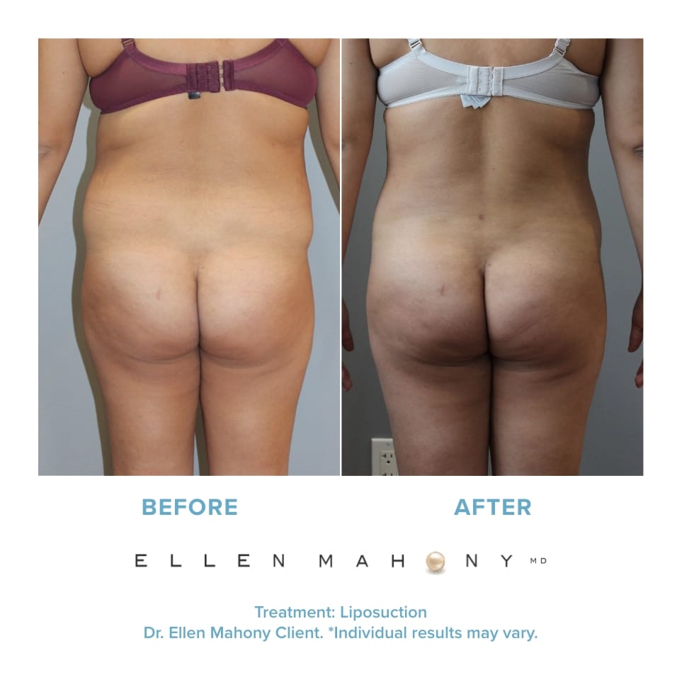 Before and After Image: Case #20916 - back