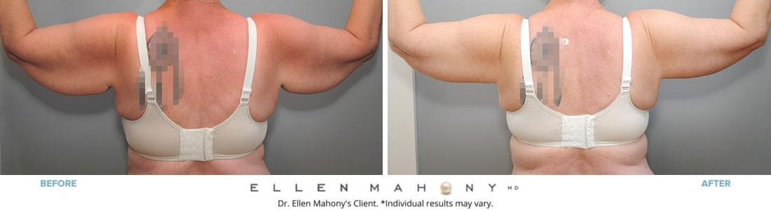 Before and After Image: Case #7236 - back
