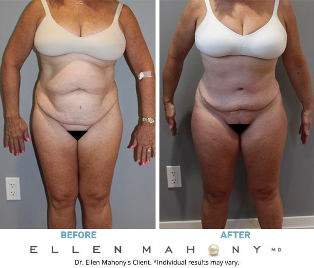 Before and After Image: Case #11882 - front
