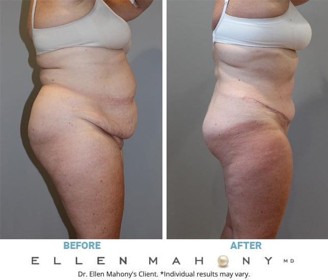 Before and After Image: Case #11882 - right-side