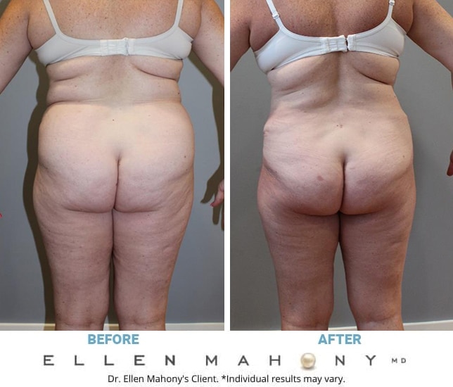 Before and After Image: Case #11882 - back