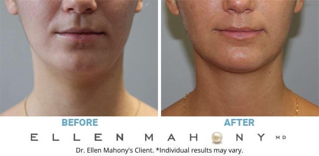 Before and After Image: Case #11566 - front
