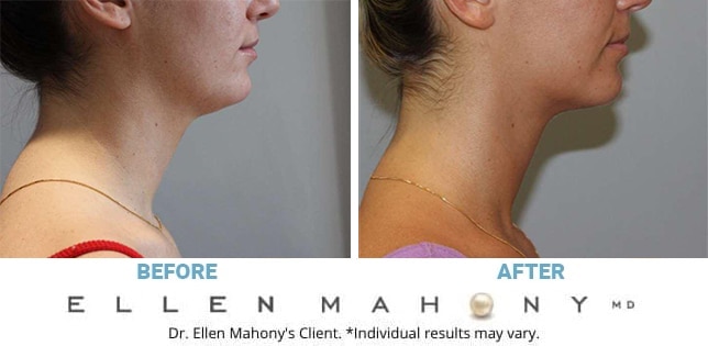 Before and After Image: Case #11566 - right-side