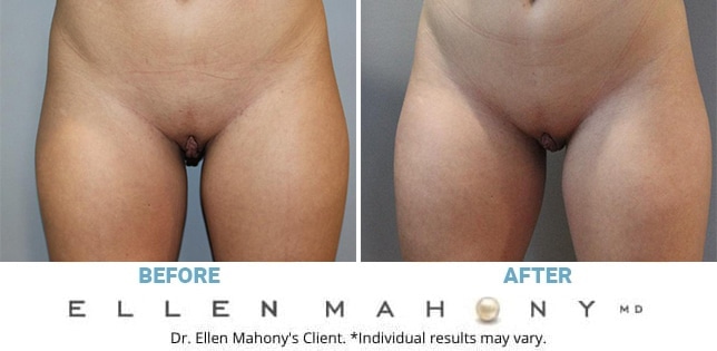 Before and After Image: Case #12310 - front