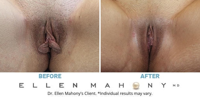 Before and After Image: Case #12299 - front
