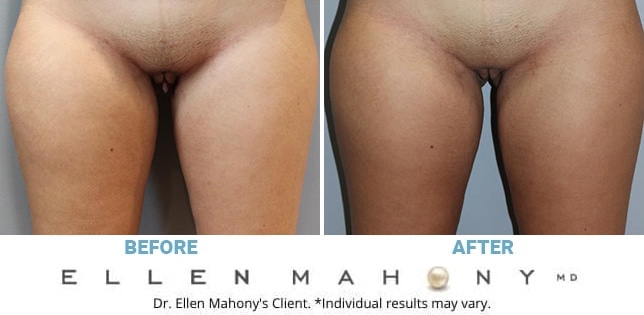Before and After Image: Case #12299 - front