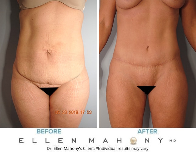 Before and After Image: Case #8255 - front