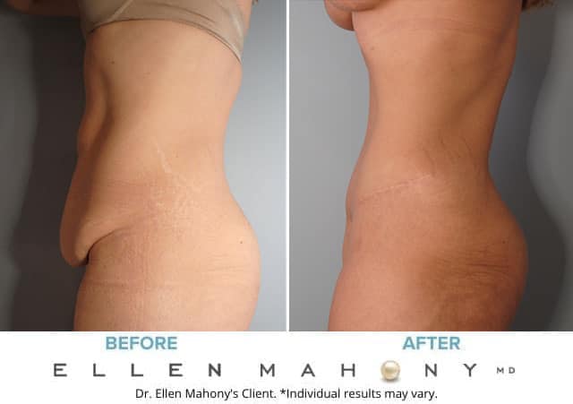 Before and After Image: Case #8255 - left-side