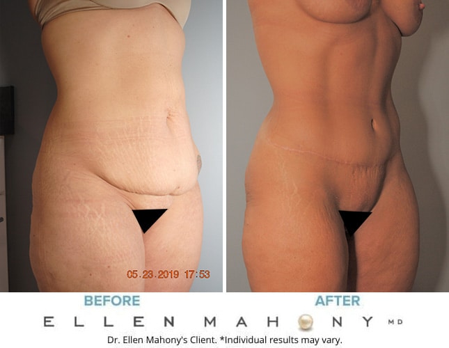 Before and After Image: Case #8255 - right-front-oblique