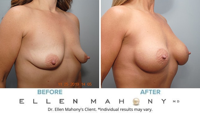 Before and After Image: Case #8255 - right-front-oblique