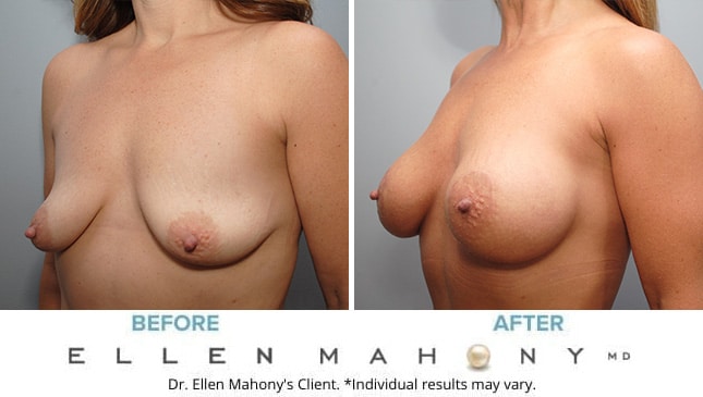 Before and After Image: Case #8255 - left-front-oblique