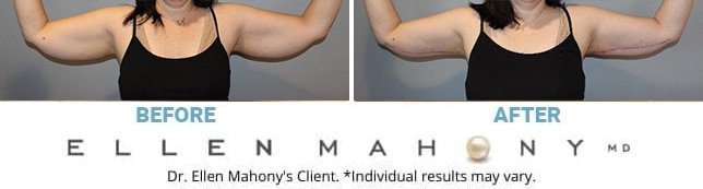 Before and After Image: Case #13223 - front