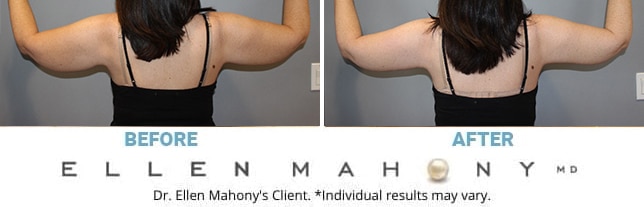 Before and After Image: Case #13223 - back