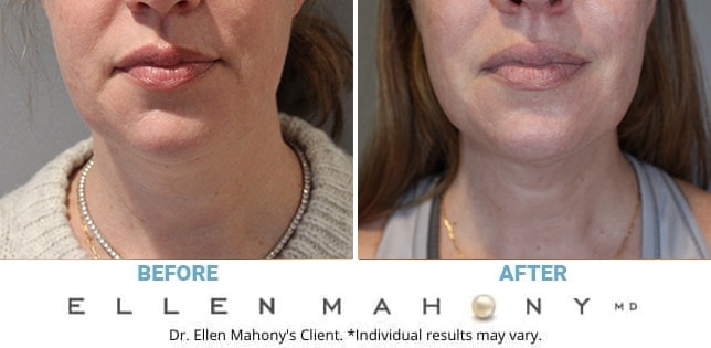 Before and After Image: Case #13278 - front