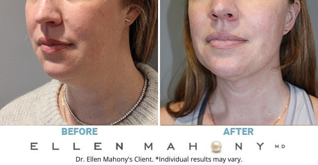Before and After Image: Case #13278 - left-front-oblique