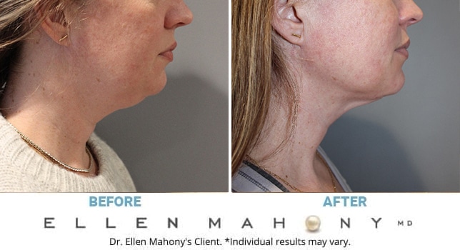 Before and After Image: Case #13278 - right-side