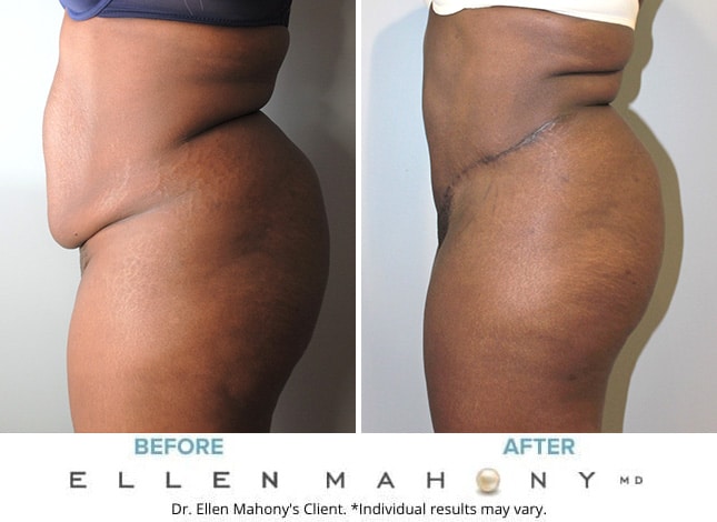 Before and After Image: Case #9749 - left-side