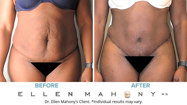 Before and After Image: Case #9749 - front