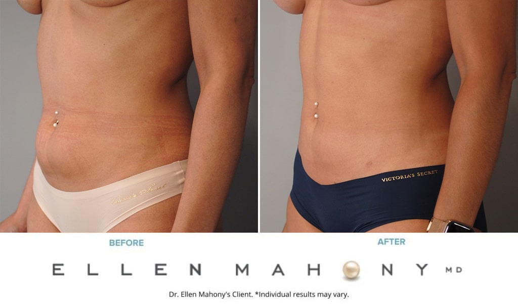 Before and After Image: Case #9929 - left-front-oblique