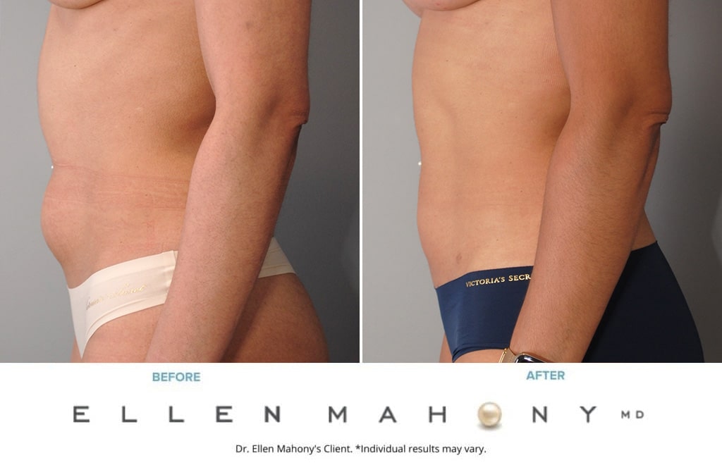 Before and After Image: Case #9929 - left-side