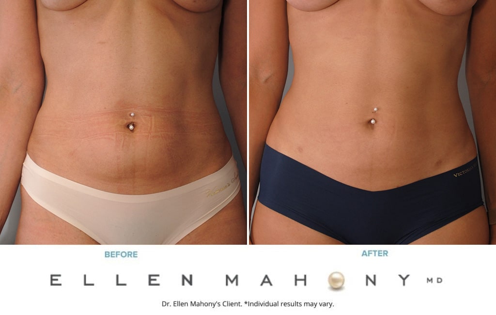 Before and After Image: Case #9929 - front