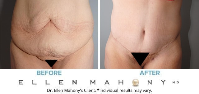 Before and After Image: Case #8080 - front