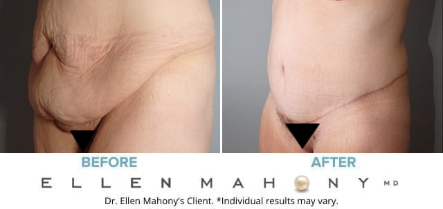 Before and After Image: Case #8080 - left-front-oblique
