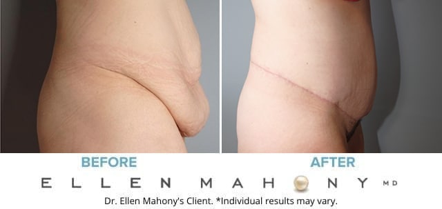 Before and After Image: Case #8080 - right-side