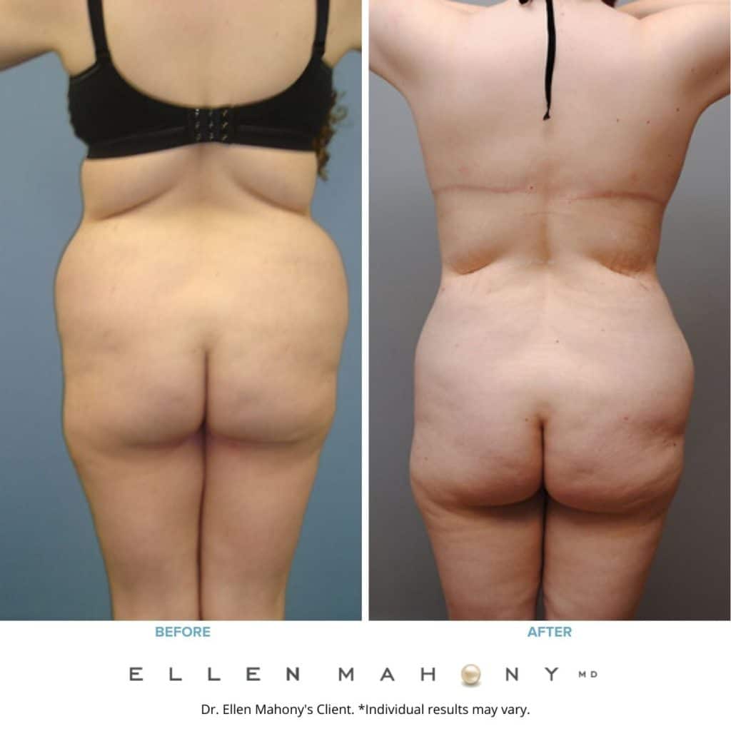 Before and After Image: Case #2088 - back