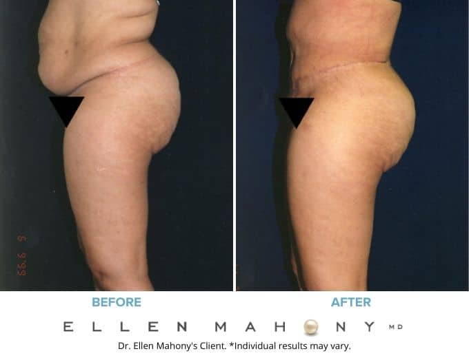 Before and After Image: Case #2093 - left-side