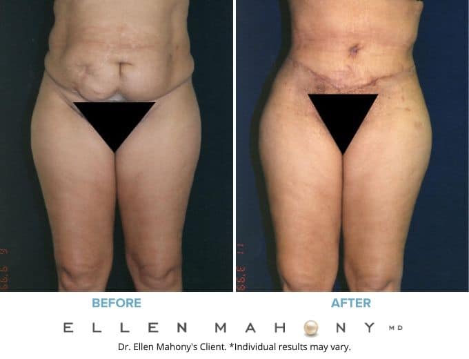 Before and After Image: Case #2093 - front