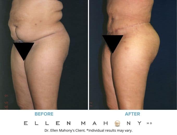 Before and After Image: Case #2093 - left-front-oblique