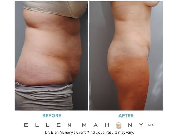 Before and After Image: Case #2098 - front