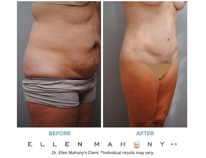 Before and After Image: Case #2098 - right-front-oblique