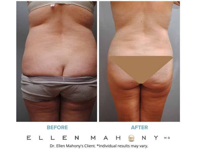 Before and After Image: Case #2098 - back