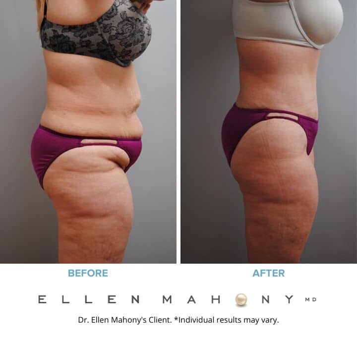 Before and After Image: Case #2113 - right-side