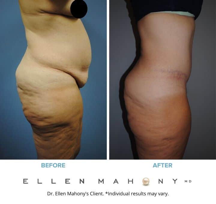 Before and After Image: Case #2120 - right-side