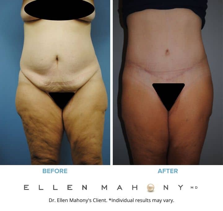 Before and After Image: Case #2120 - front